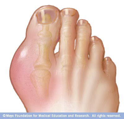 How Many People Have Gout Info.